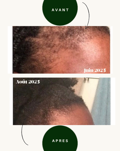 Pack Rituel Floraison - Huile Stimulante & Anti-casse + Masseur Lumière Rouge Cheveux Crépus - Oëyya