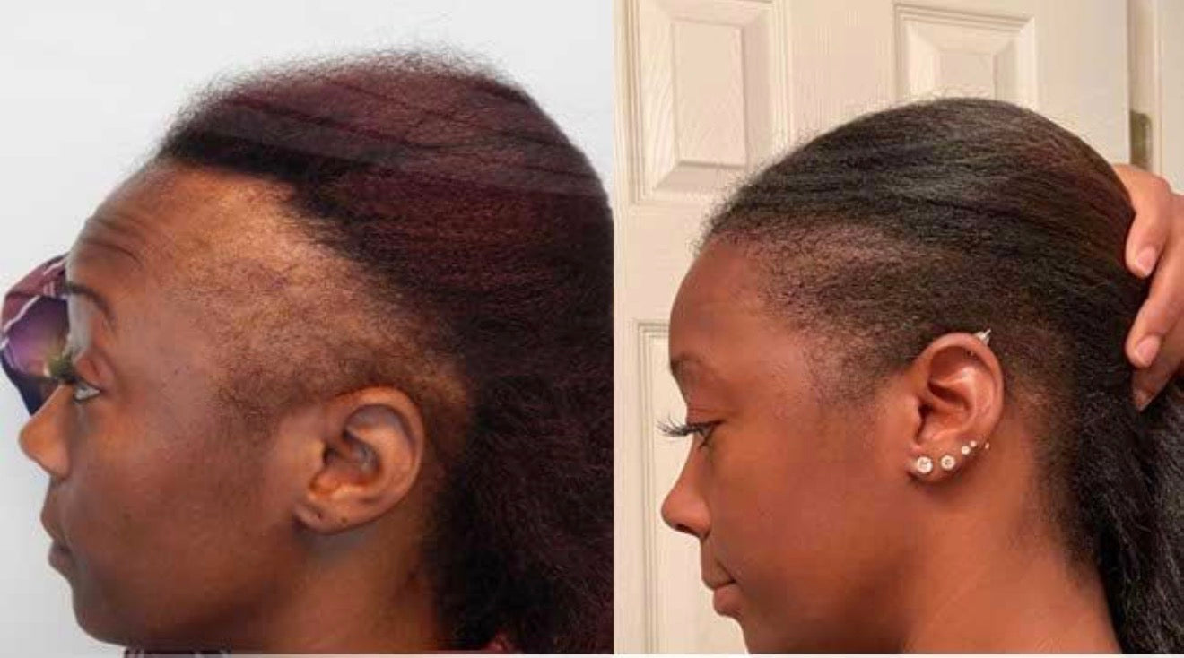 Huile pousse cheveux crépus - Romarin & Ricin Noir