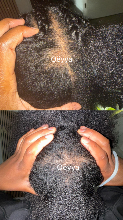Stimulateur de Follicules à Lumière Rouge — Massage Cuir Chevelu pour Pousse & Rétention | Cheveux Crépus | Oëyya